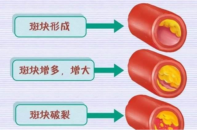 慈能灸石 | 高血脂的“根源”找到了，1個原因常被忽視，試試1物，幫助降血脂